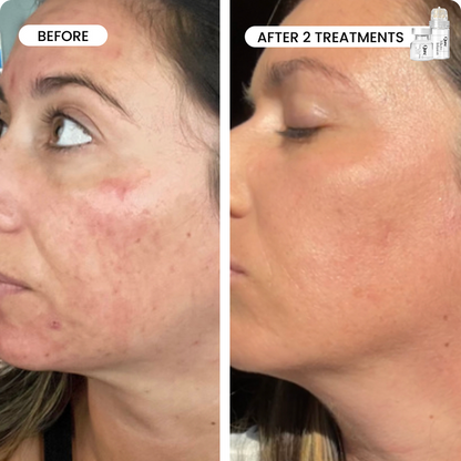 Micro-Infusion 3 Month Bundle (For Wrinkles) – Includes Hypochlorous Acid Spray