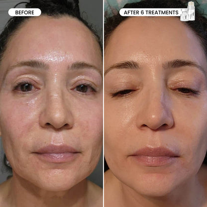 Micro-Infusion 3 Month Bundle (For Wrinkles) – Includes Hypochlorous Acid Spray